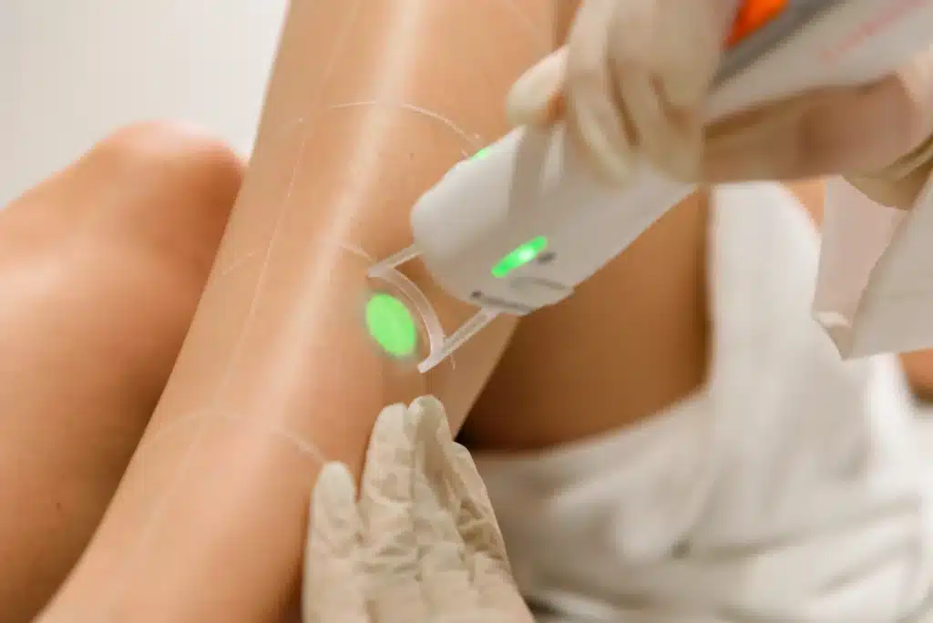 Épilation laser sur une jambe